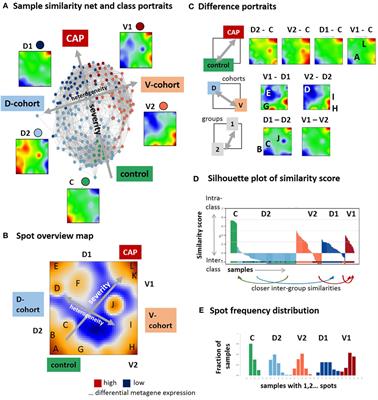 Footprints of Sepsis Framed Within Community Acquired Pneumonia in the Blood Transcriptome